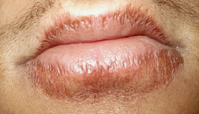 9 Things Your Lips Say About Your Health—[Tingling Lips May Signify a Stroke is coming]