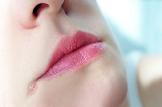 9 Things Your Lips Say About Your Health—[Tingling Lips May Signify a Stroke is coming]