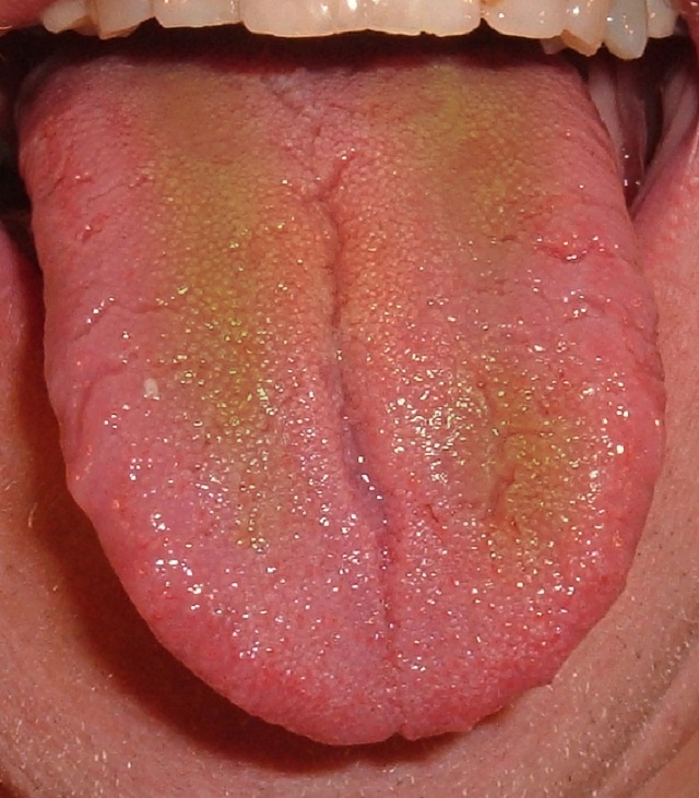 6 Things Your Tongue Says About Your Health [Bright Red Tongue Means See A Doctor]