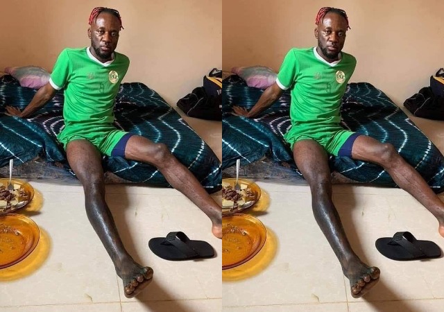 Prominent Sierra Leone Striker Mohamed Buya Turay Shows Off What Black Magic Did To His Leg [photos]