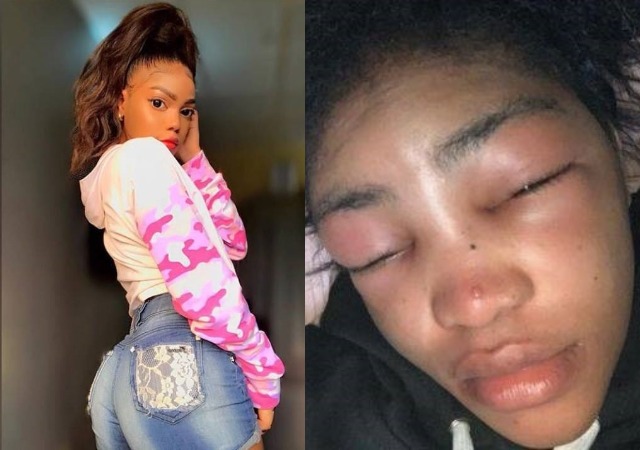 Check Out Recent Photos of Lil Frosh Ex-Girlfriend One Month after Being Assaulted