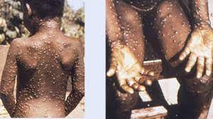 U.S. Confirms Monkeypox In America Blames Nigeria