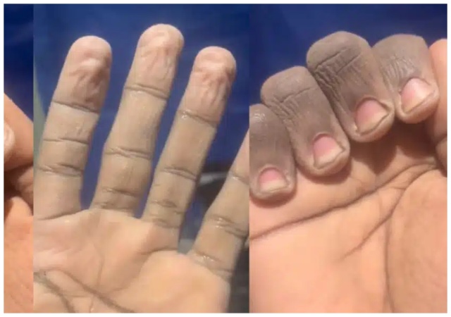 A UK-based Nigerian man shared a photo of his hands after washing plates for 12 hours