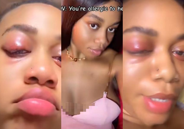 “I’m allergic to heat too, but e never reach like this” -Nigerian lady’s heat allergy reaction sparks debate online