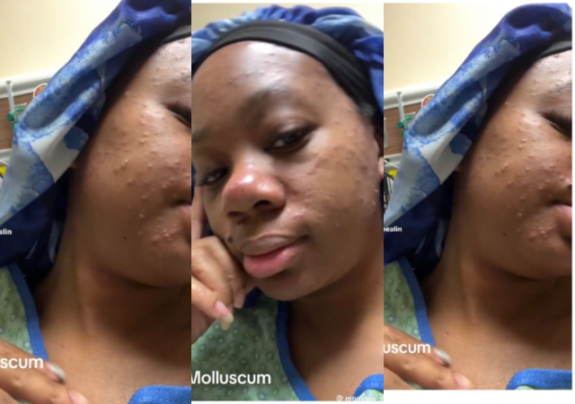 Lady asserts she contracted a skin infection, 'Molluscum Contagiosum' after buying a wig online 