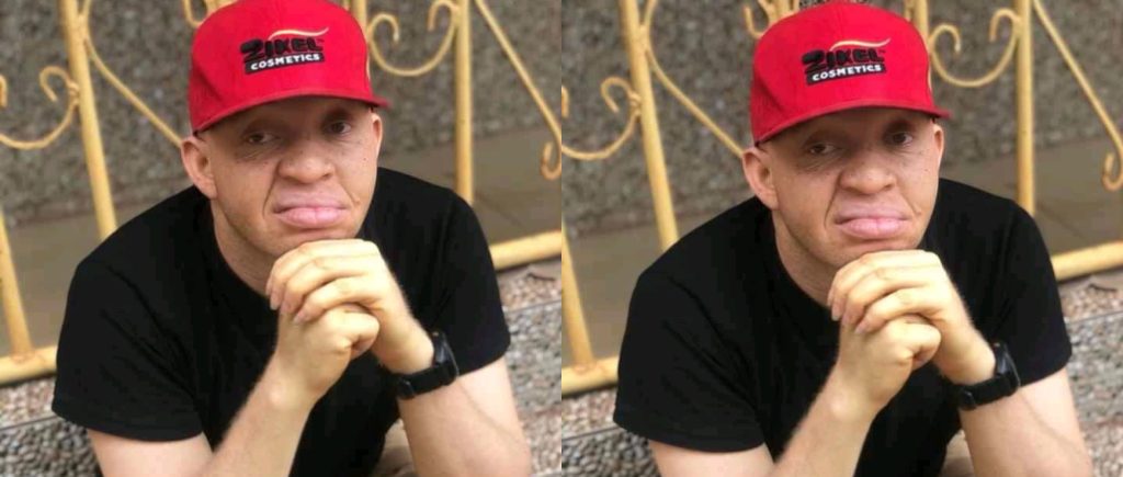 Man Urges People with Albinism to Embrace Their Uniqueness