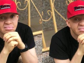 Man Urges People with Albinism to Embrace Their Uniqueness